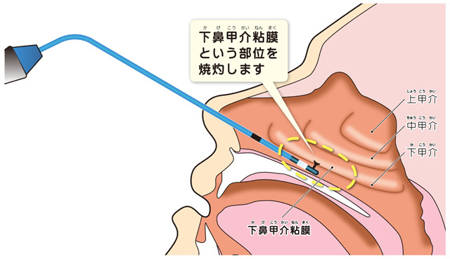 かさぶた 鼻 粘膜